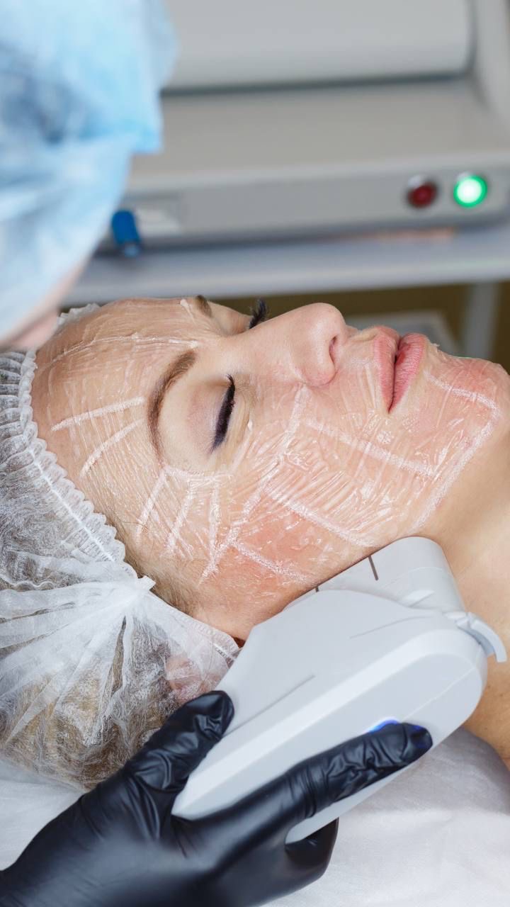 Tecnología HIFU para rostro