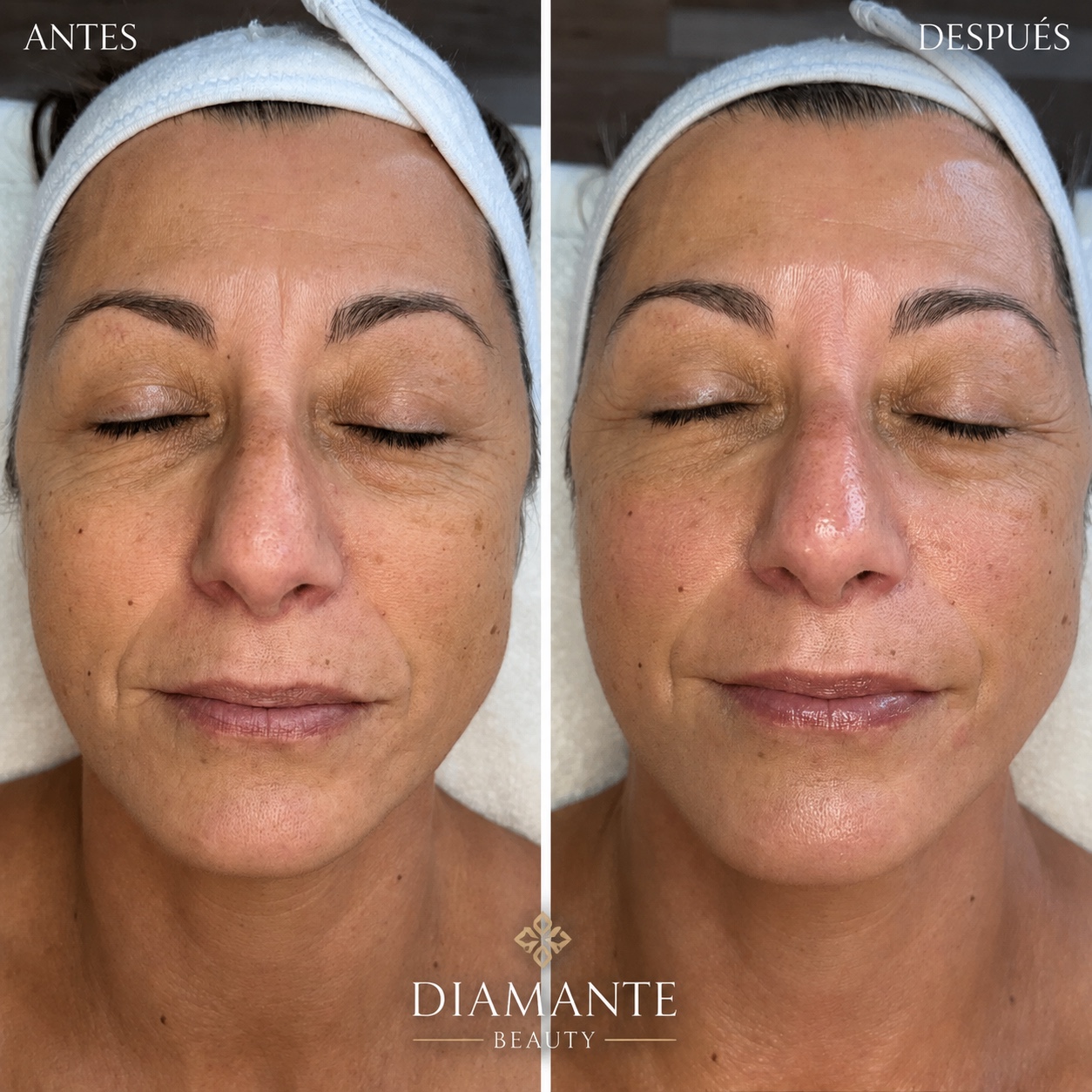 Resultado facial antes y después