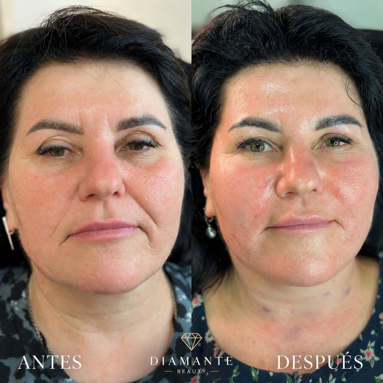 Resultado facial antes y después