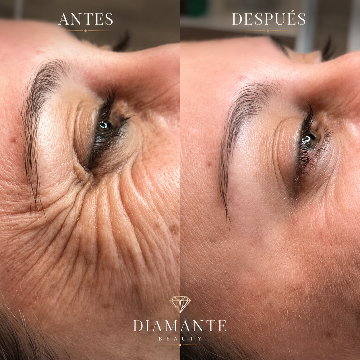 Resultado facial antes y después
