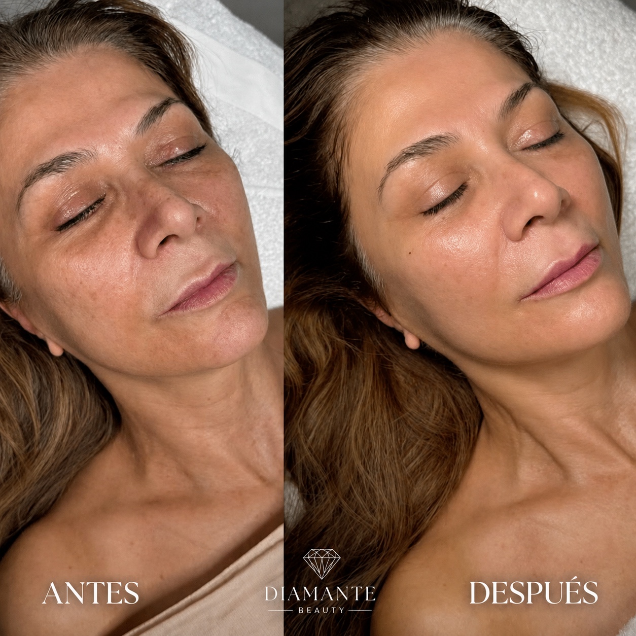 Resultado facial antes y después
