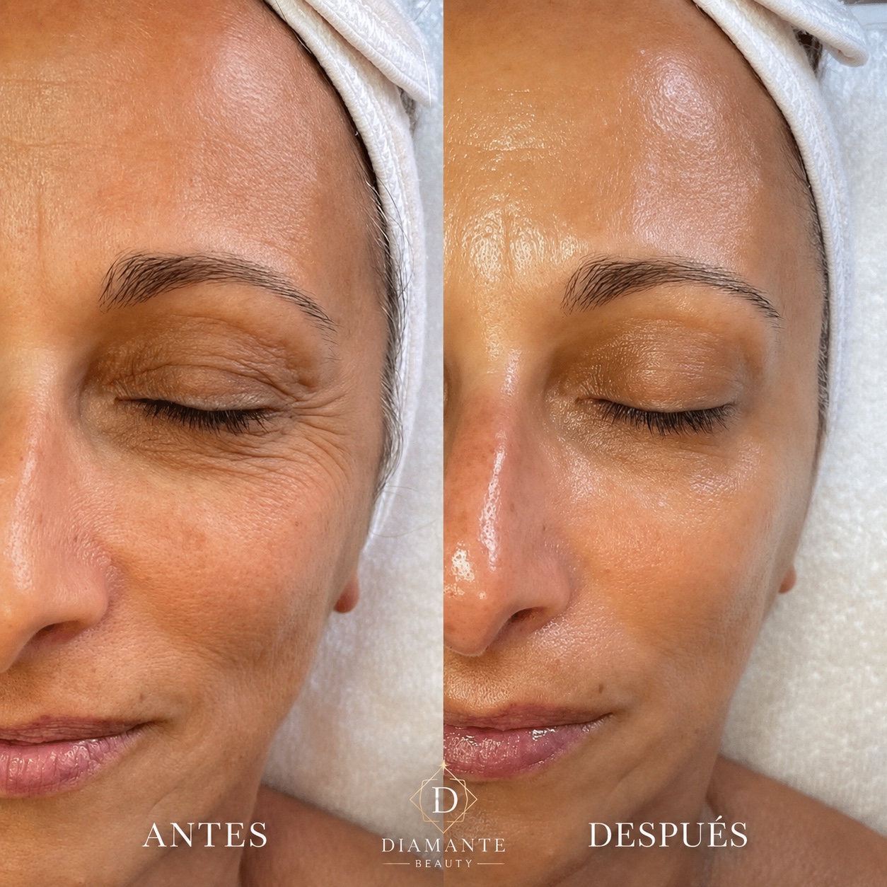Resultado facial antes y después